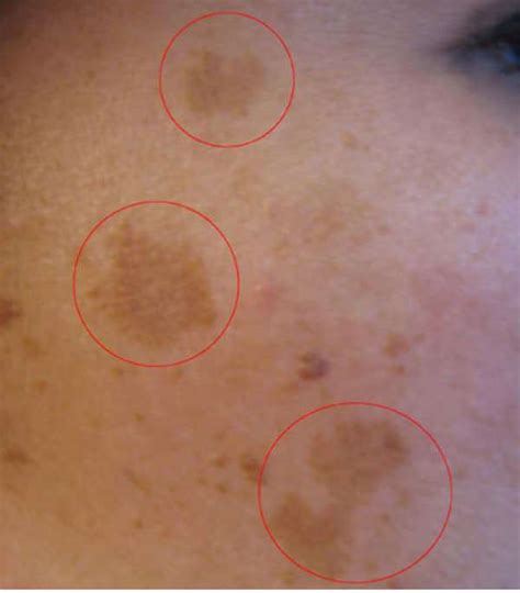 面上有黑斑|黑斑 (Melasma)